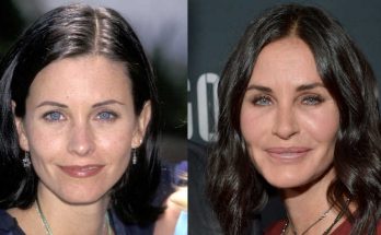 Courteney Cox Botox