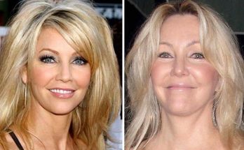 Heather Locklear Botox