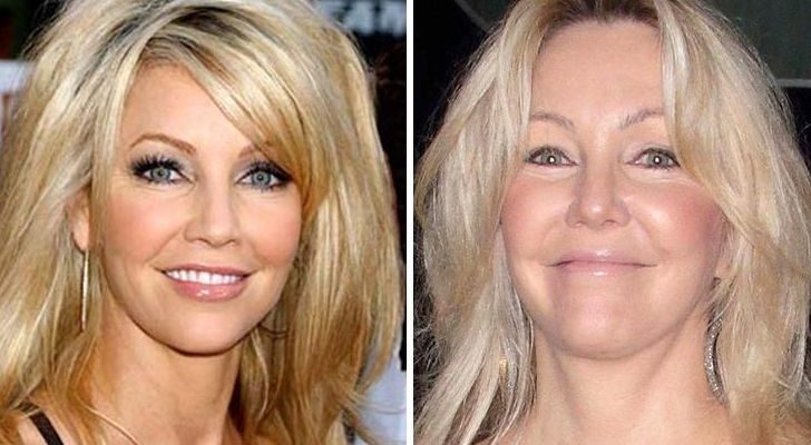 Heather Locklear Botox