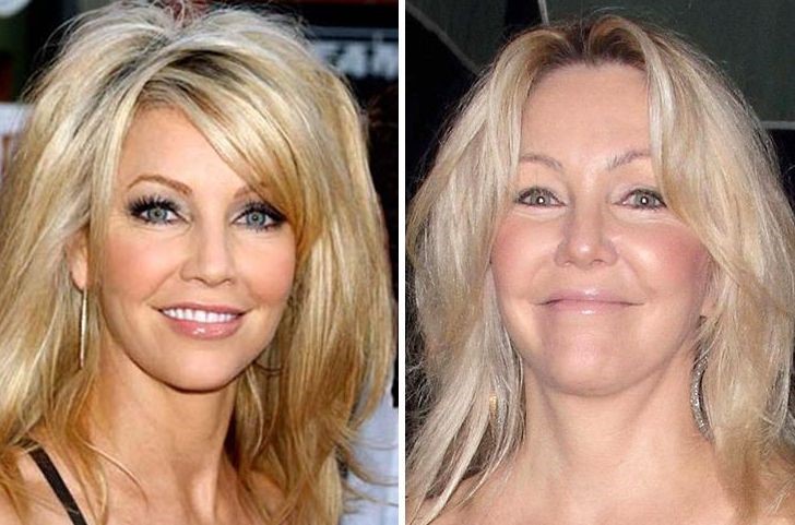 Heather Locklear Before And After Plastic Surgery Including Botox And