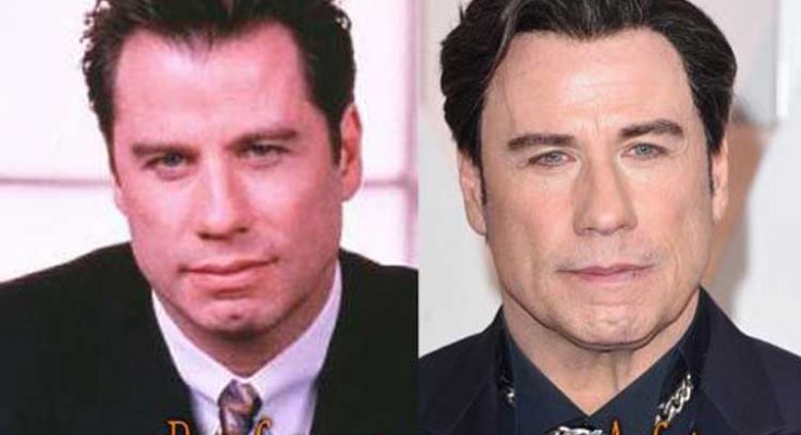 John Travolta Facelift Before After