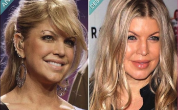 Fergie Cosmetic Surgery