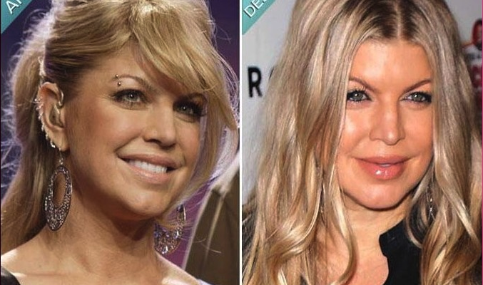 Fergie Cosmetic Surgery