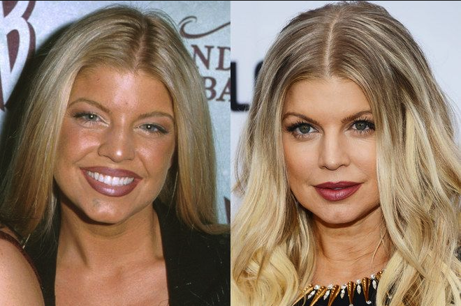 Fergie Nose Job