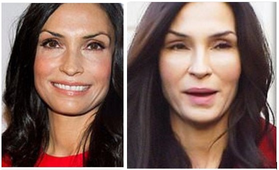 Famke Janssen Botox