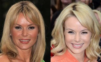 Amanda Holden Botox