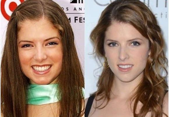 Anna Kendrick Nose Job