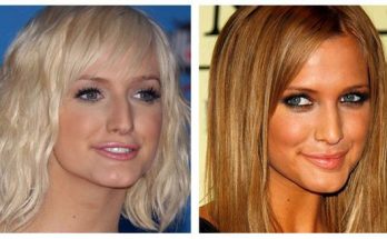 Ashlee Simpson Lip Injections