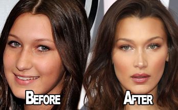 Bella Hadid Nose Job