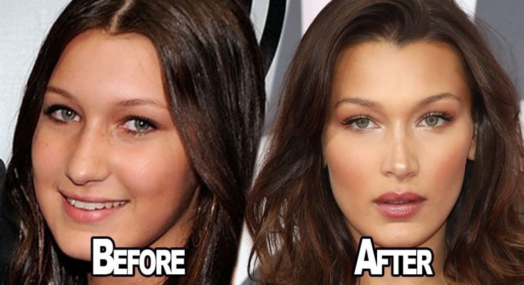 Bella Hadid Nose Job