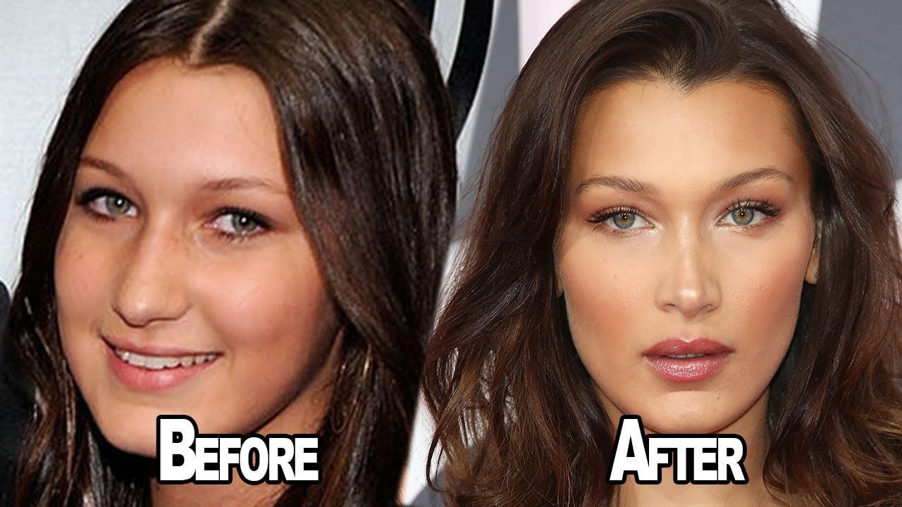 Bella Hadid Before And After Plastic Surgery Including Nose Job And Lips Famous Plastic Surgeries