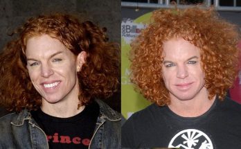 Carrot Top Botox Facelift