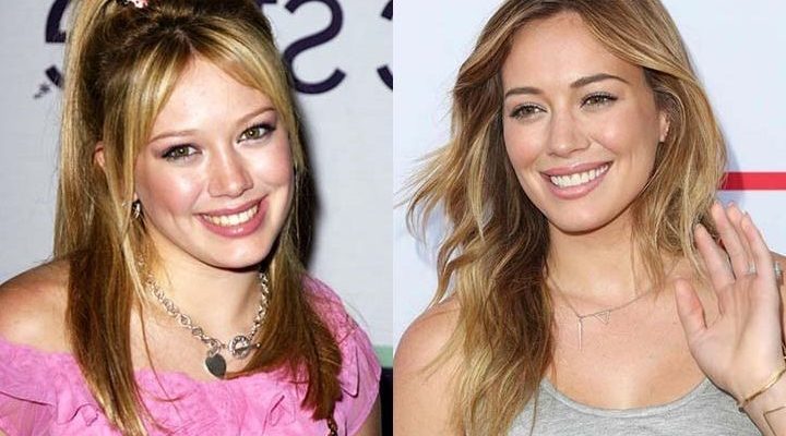 Hillary Duff Plastic Surgery