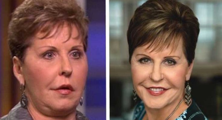 Joyce Meyer Facelift Before After