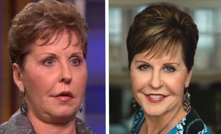 Did Joyce Meyer Undergo Plastic Surgery Including Facelift and Lips? 