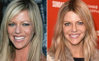 Kaitlin Olson Botox