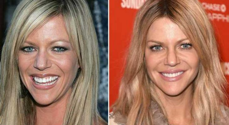 Kaitlin Olson Botox