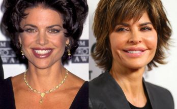 Lisa Rinna Lip Injections