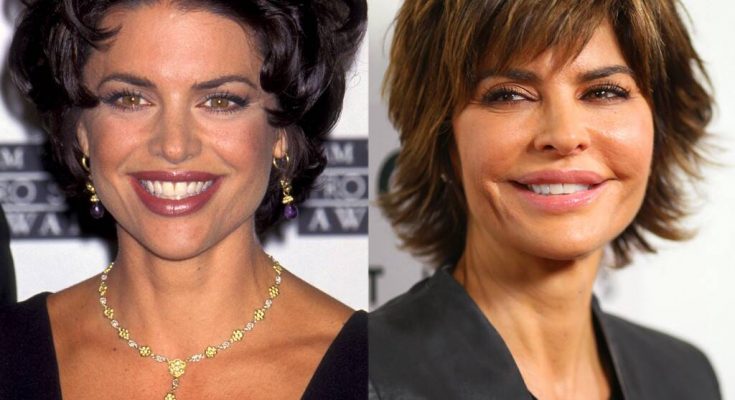 Lisa Rinna Lip Injections