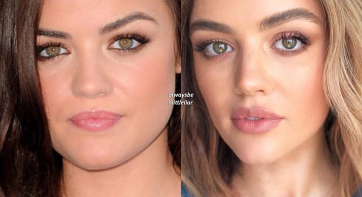 Lucy Hale Nose Job