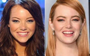 Emma Stone Nose Job