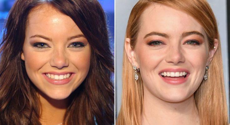 Emma Stone Nose Job