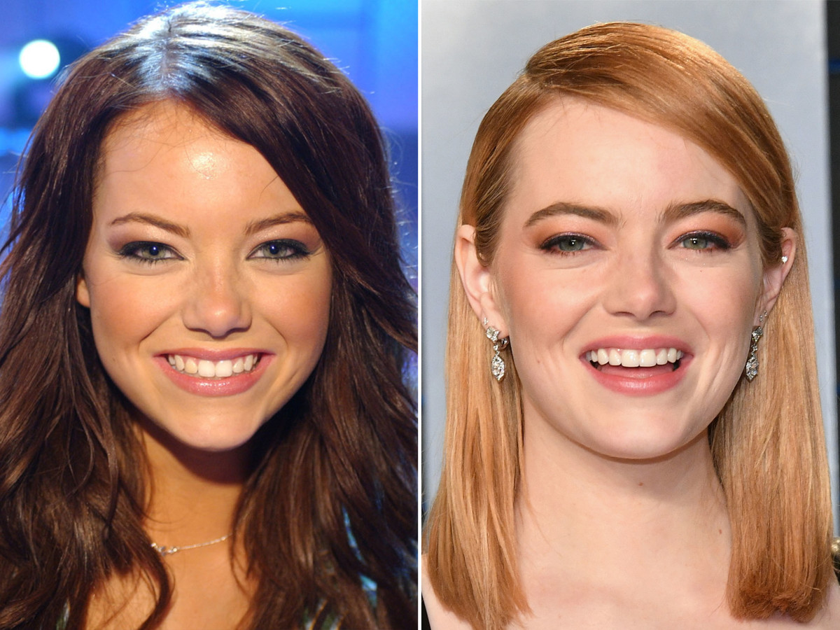 Emma Stone Nose Job