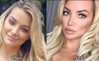 Lindsey Pelas Plastic Surgery Nose Job Boob Job