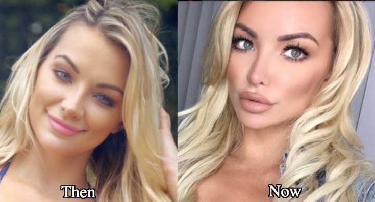 Lindsey Pelas Plastic Surgery Nose Job Boob Job