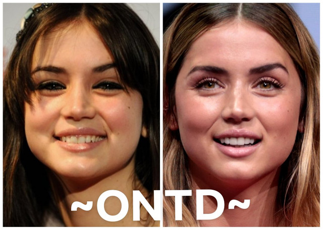 Ana de Armas Lips Plastic Surgery