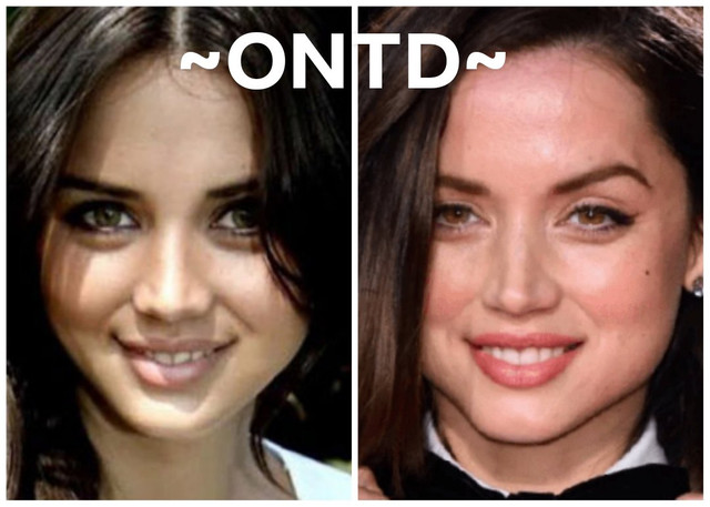 Ana de Armas Nose Job Plastic Surgery