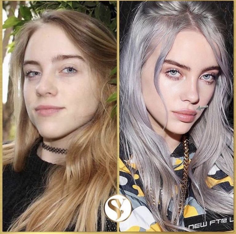 Billie Eilish Lips Plastic Surgery