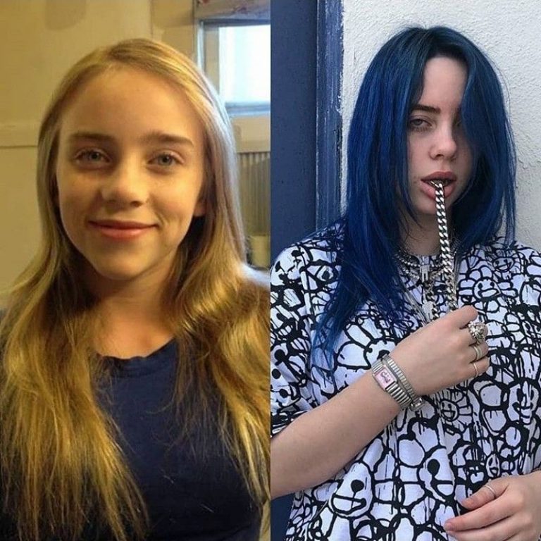 Billie Eilish Nose Job Plastic Surgery