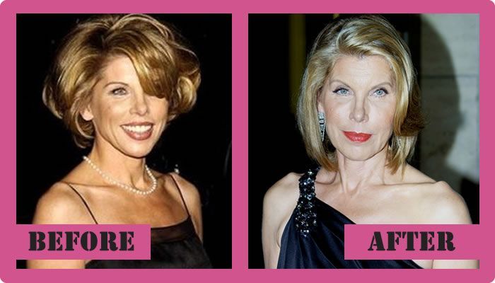 Christine Baranski Nose Job Plastic Surgery