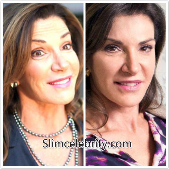 Hilary Farr Nose Job Plastic Surgery