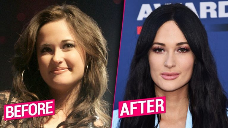 Kacey Musgraves Lips Plastic Surgery