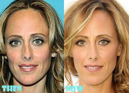 Kim Raver Nose Job Plastic Surgery