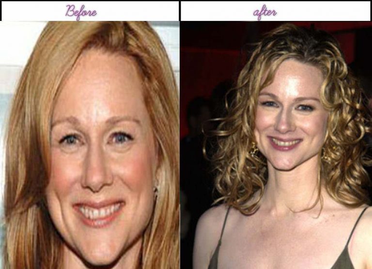 Laura Linney Nose Job Plastic Surgery