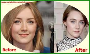 Saoirse Ronan Nose Job Plastic Surgery