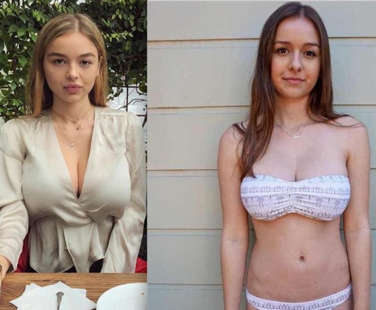 Sophie Mudd Nose Job Plastic Surgery