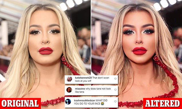 Tana Mongeau Lips Plastic Surgery