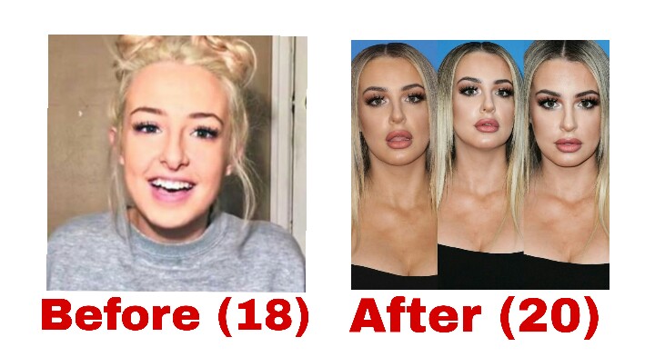 Tana Mongeau Boob Job