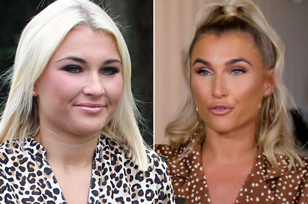 Billie Faiers Botox Nose Job Lips Plastic Surgery Rumors