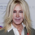 Joan Van Ark Plastic Surgery