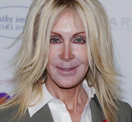 Joan Van Ark Plastic Surgery